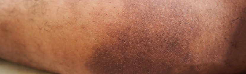 Before & After Dark Underarm Treatment