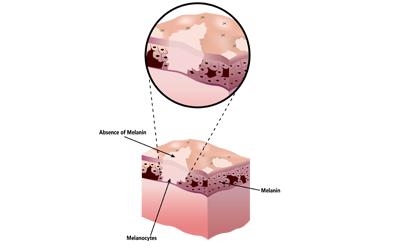 Melanin: The Science Behind Skin Color, Protection, and Hyperpigmentation